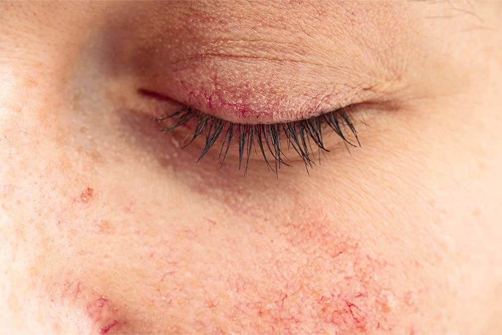 Harnessing Red Light Therapy For Rosacea Relief