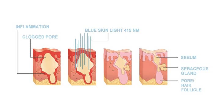 What is Light Therapy? And What Are Its Benefits?