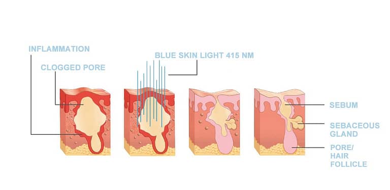 What is Light Therapy? And What Are Its Benefits?