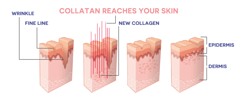 CollaTan Reaches Human Skin