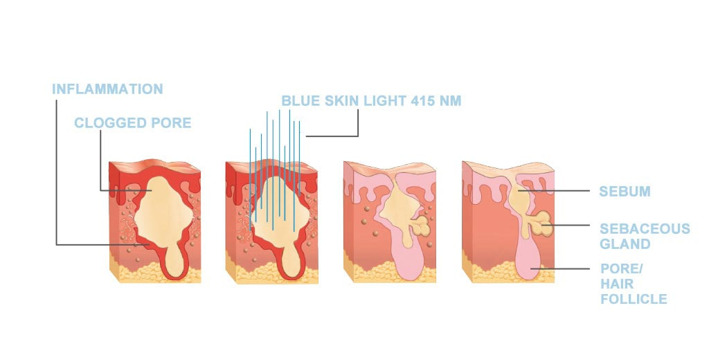 Dr. Muller Blue Skin Light impact on the skin