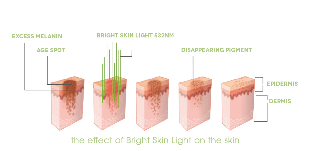 My Dr. Muller Bright Skin Light impact on skin