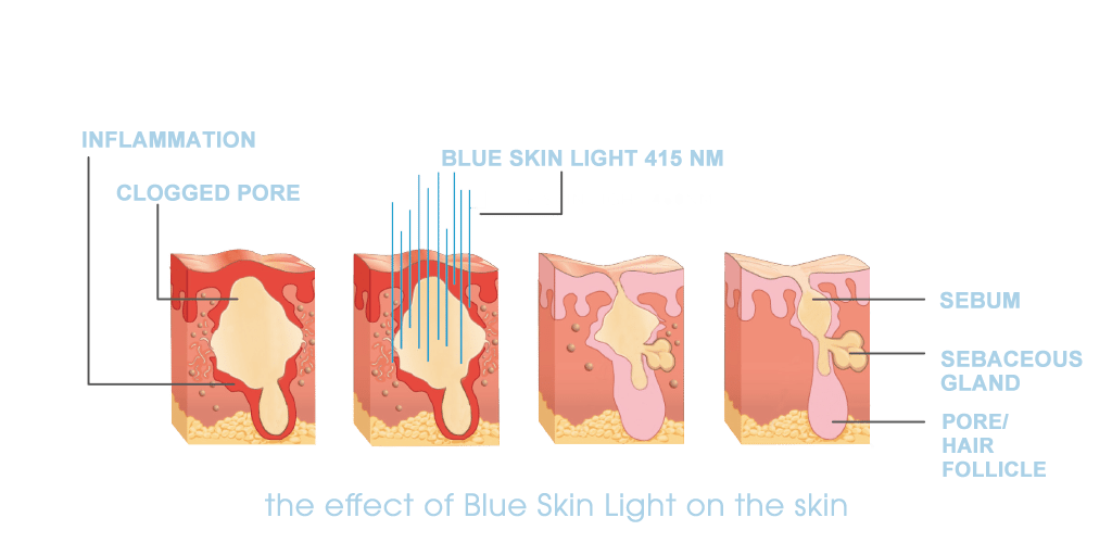 Dr. Muller blue skin light impact on the skin