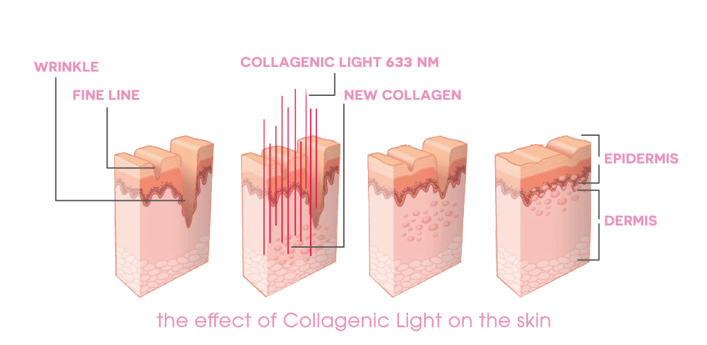 Dr. Muller the effect of collagenic light on the skin